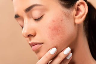 Face acne scars