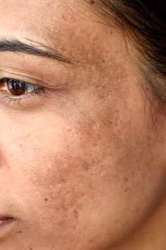 Dark Spots & Dullness