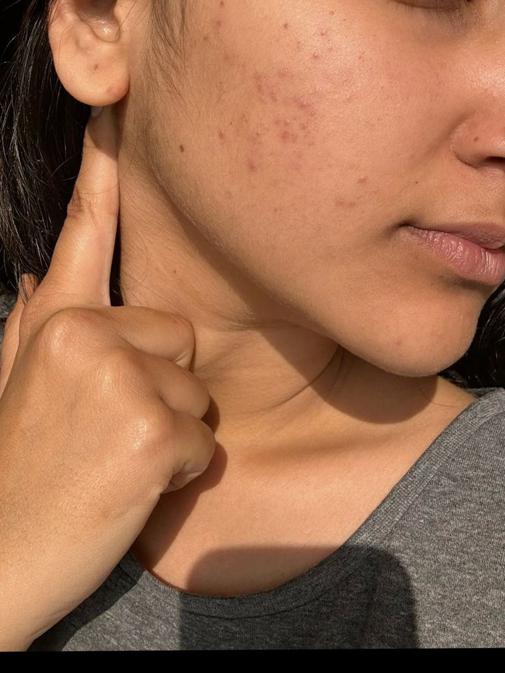 Pores & Breakouts