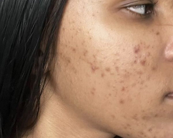 Pores & Breakouts