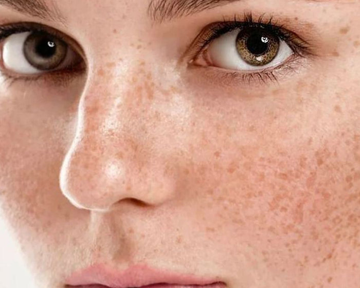 Dark Spots & Dullness