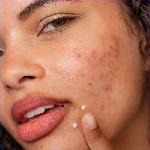 Post-Blemish Marks