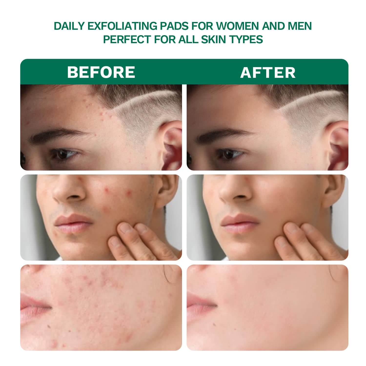 before and after of  Salicylic Acid 